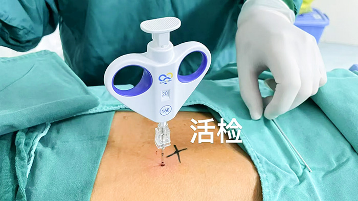 肺癌能治好吗 早期治愈成功性很高