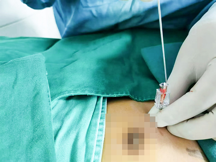 黏膜修复,黏膜炎症,三叉神经痛,上颌骨囊肿,过敏性鼻炎,鼻腔冲洗,抗生素治疗,抗组胺药,鼻用激素,鼻窦炎