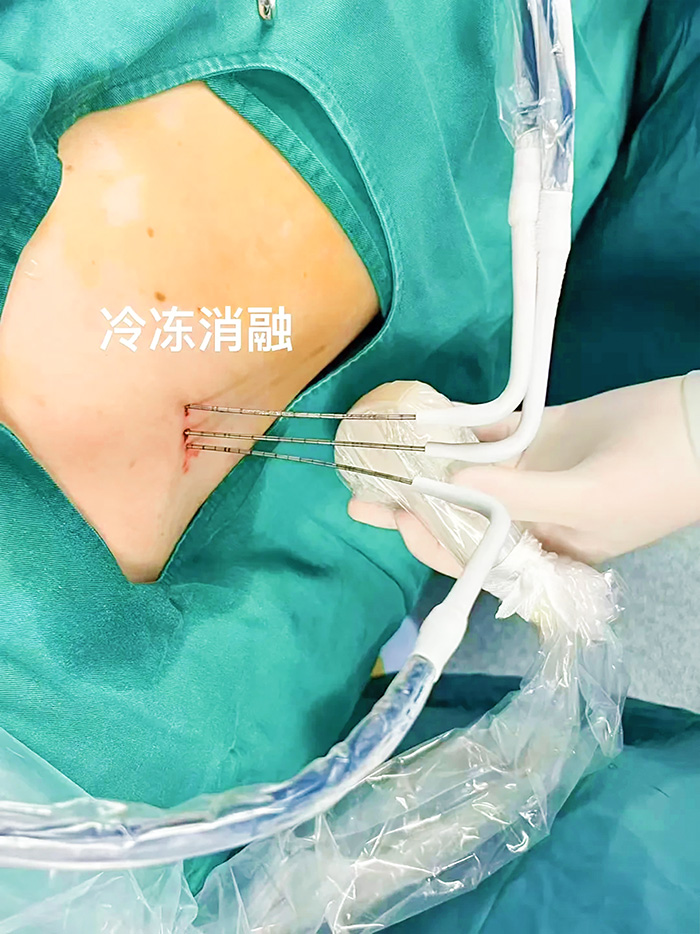 如何诊断肝癌 这样做治疗及时