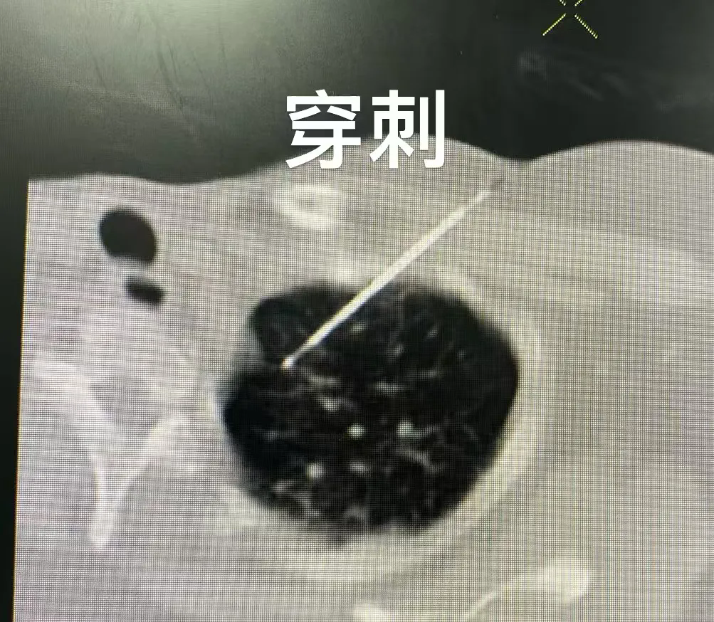 最常见的3个胃癌诊断方法