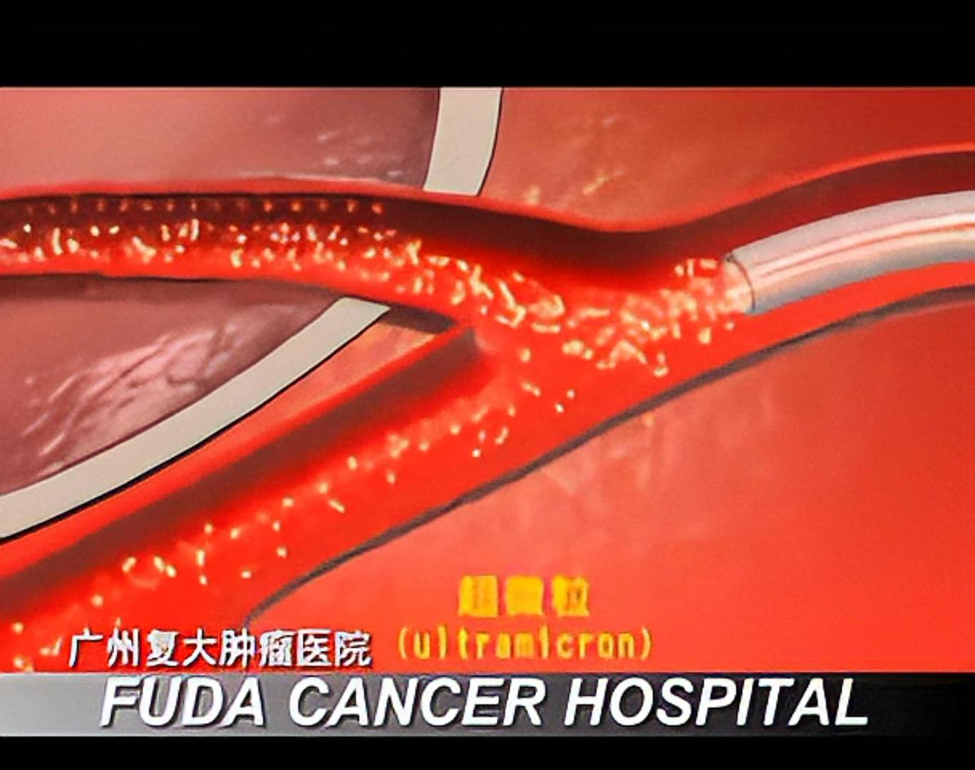 肿瘤微血管介入疗法 (CMI)