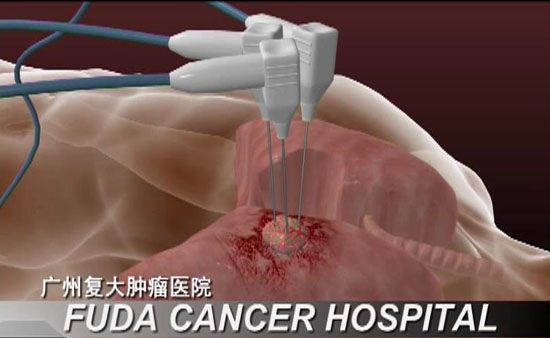 冷冻消融治疗 (CSA)