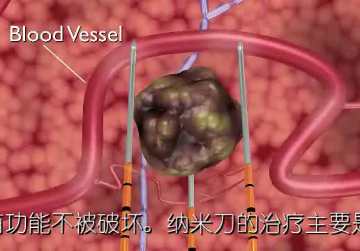 纳米刀消融疗法（IRE）