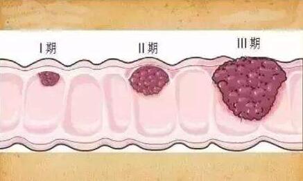 重庆口腔癌