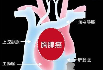 长沙胸腺癌
