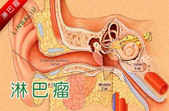温州淋巴癌