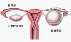 娄底附件肿瘤
