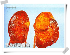 多发性汉沽骨髓癌