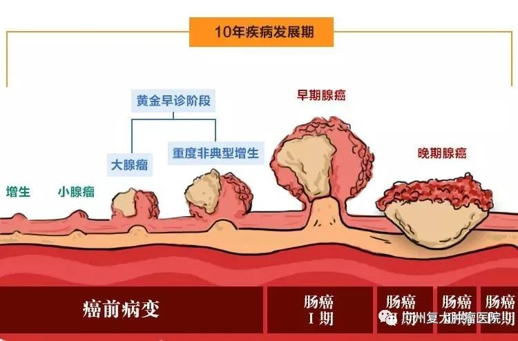 黄南肠癌发展进程