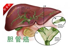 胆管癌