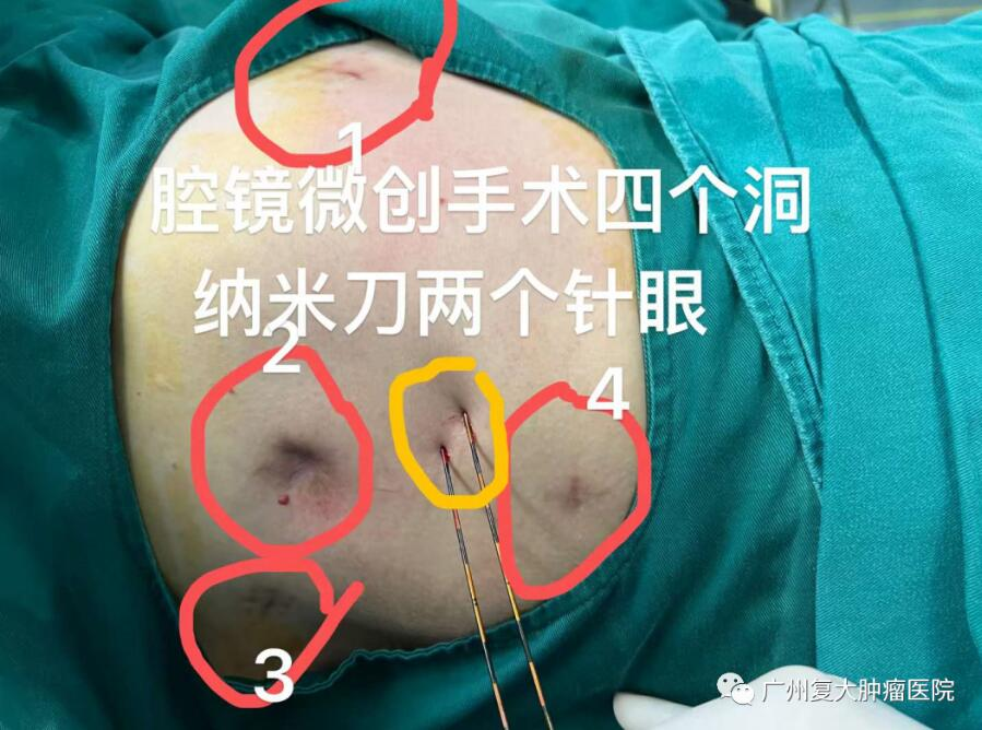 胆管癌治疗