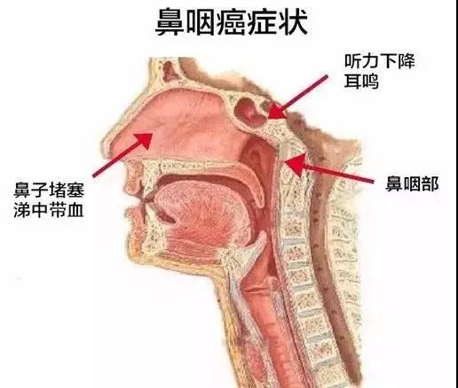女性吉安咽喉癌症状