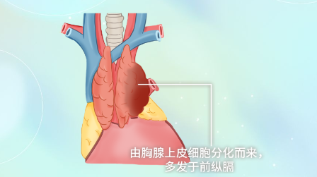 汉沽胸腺癌早期症状