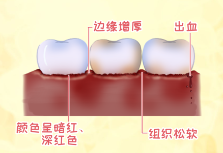 牙龈肿痛，可能是日常生活的“提醒”