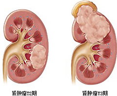 运城肾癌症状