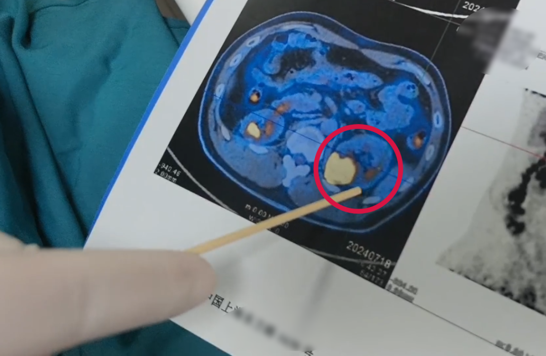 万州肾癌成因