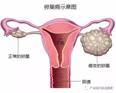 白城卵巢癌示意图