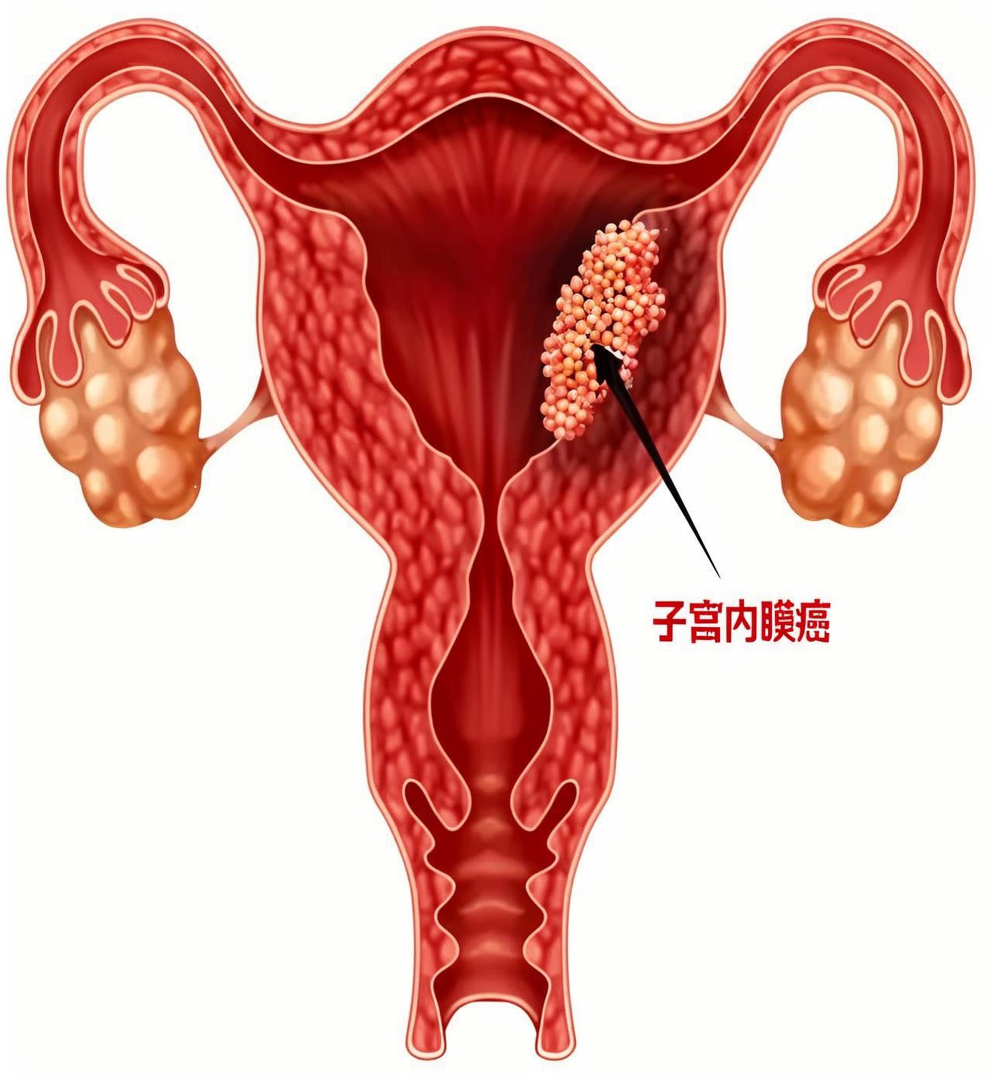 吉安子宫内膜癌是什么原因引起的