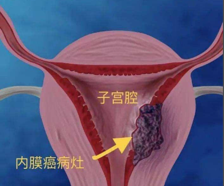 普陀子宫内膜癌的早期症状