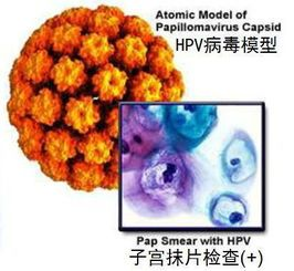 房山宫颈癌怎么治疗