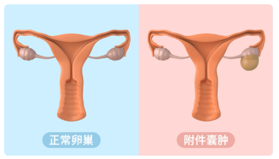 附件囊肿还是赣州附件肿瘤