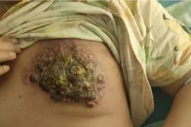 丰台乳腺癌患者