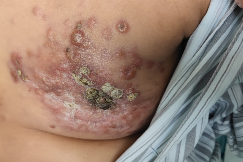 哪家医院看丰台乳腺癌好​​