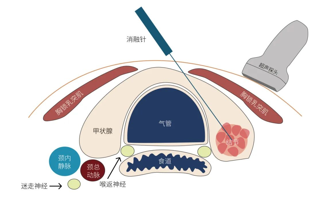 鄂尔多斯甲状腺癌治疗