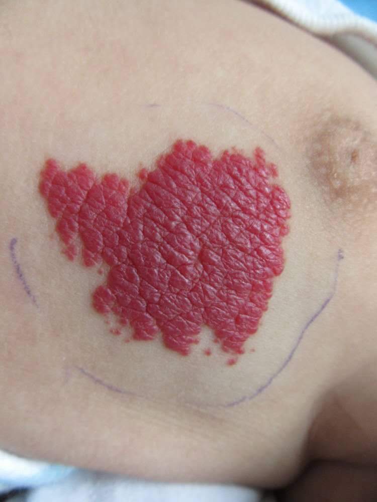 血管瘤症状