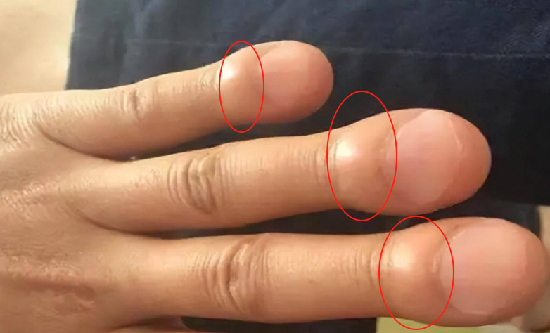 延庆骨癌早期症状