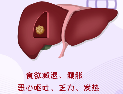沈阳肝癌的早期症状有哪些