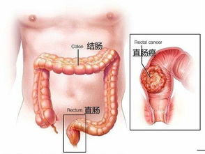 治疗直肠癌比较好的医院
