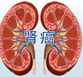 如何提升肾癌的治愈可能