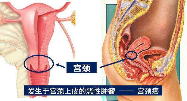 澳门半岛宫颈癌一般能活多少年?