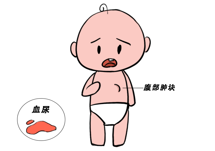 凉山肾母细胞瘤常见问题
