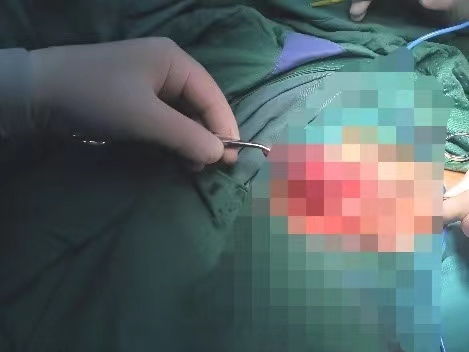 乐山阴囊肿瘤不想开刀怎么治疗