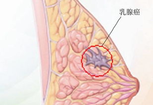 凉山乳腺癌早期症状