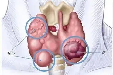 连江甲状腺癌