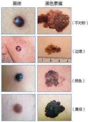 新界黑色素瘤症状