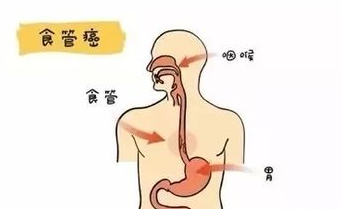 食道癌哪家医院好