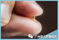 25南充碘粒子植入术