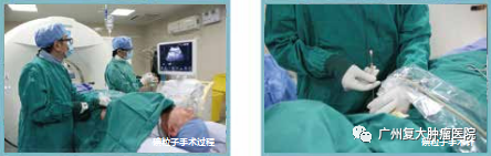 南充碘粒子疗法：小颗粒如何对抗大肿瘤？