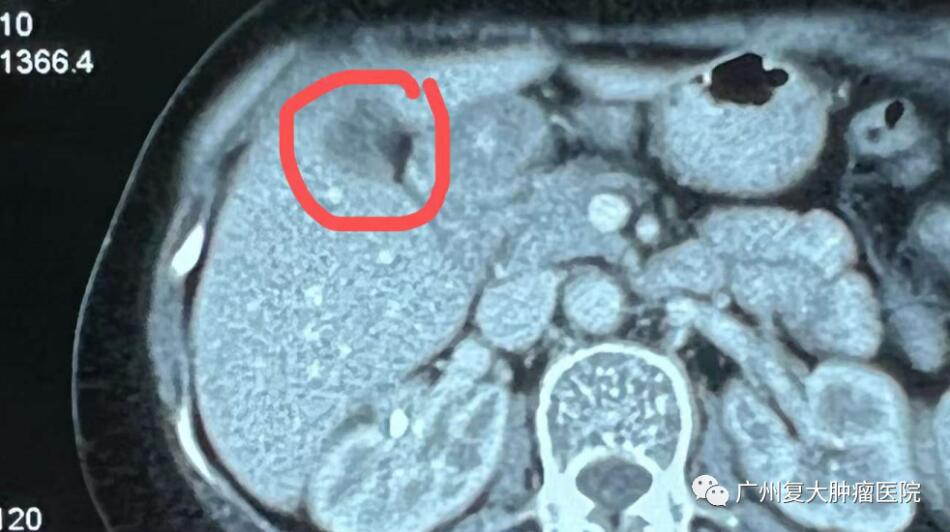 衢州衢州胆管癌非化疗治疗