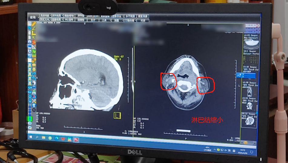 衢州衢州鼻咽癌不开刀治疗