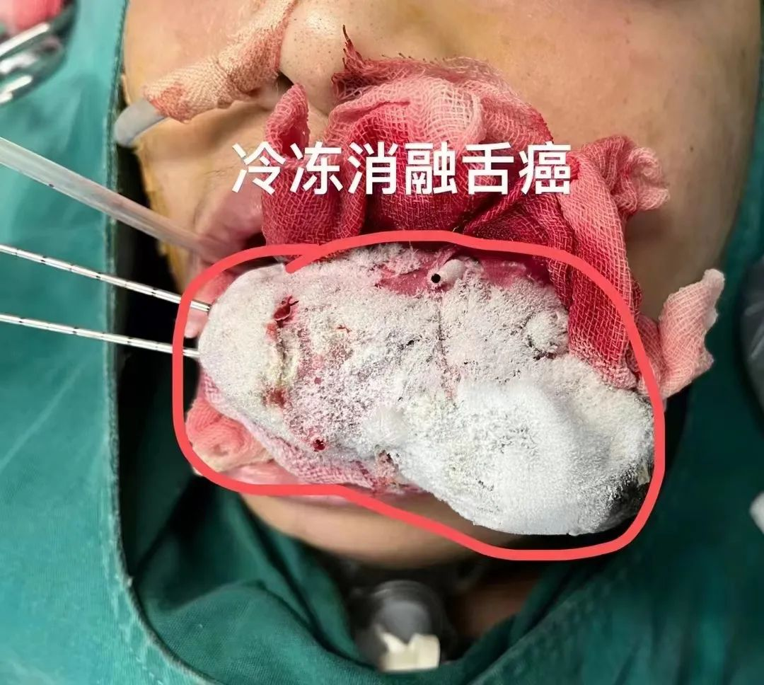 龙华治疗舌癌哪个医院好？从“保命”到“保生活”的关键选择