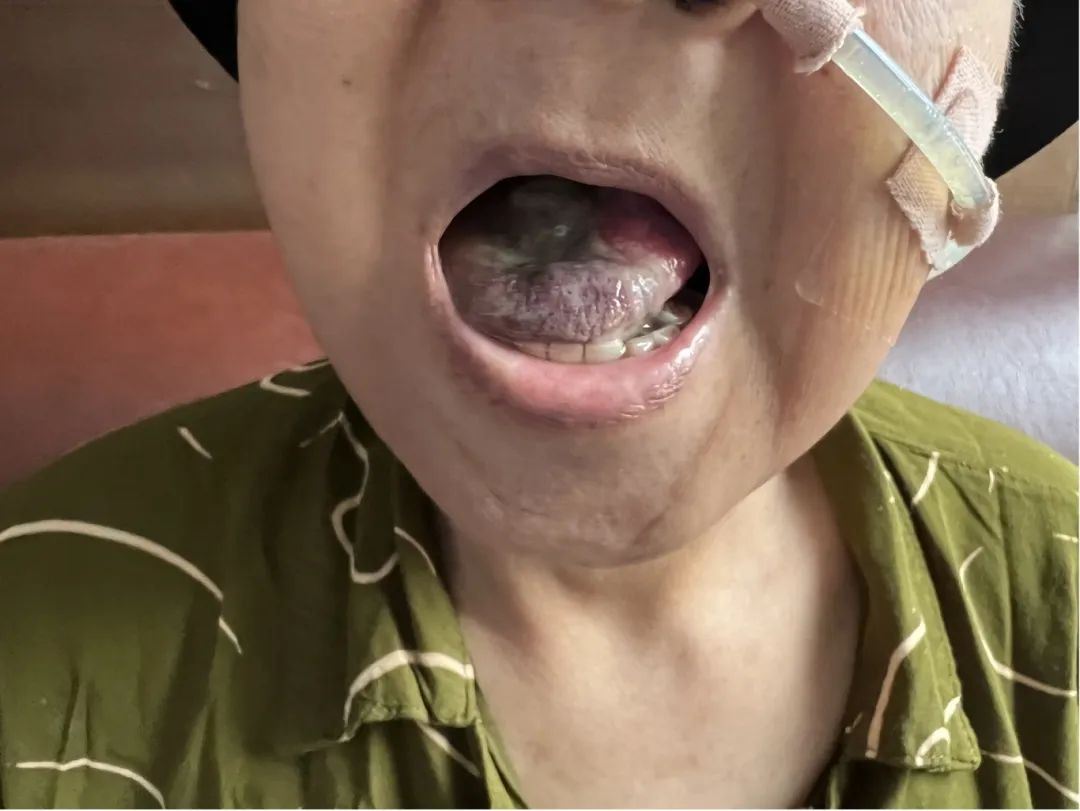 龙华中医治疗舌癌效果好吗？