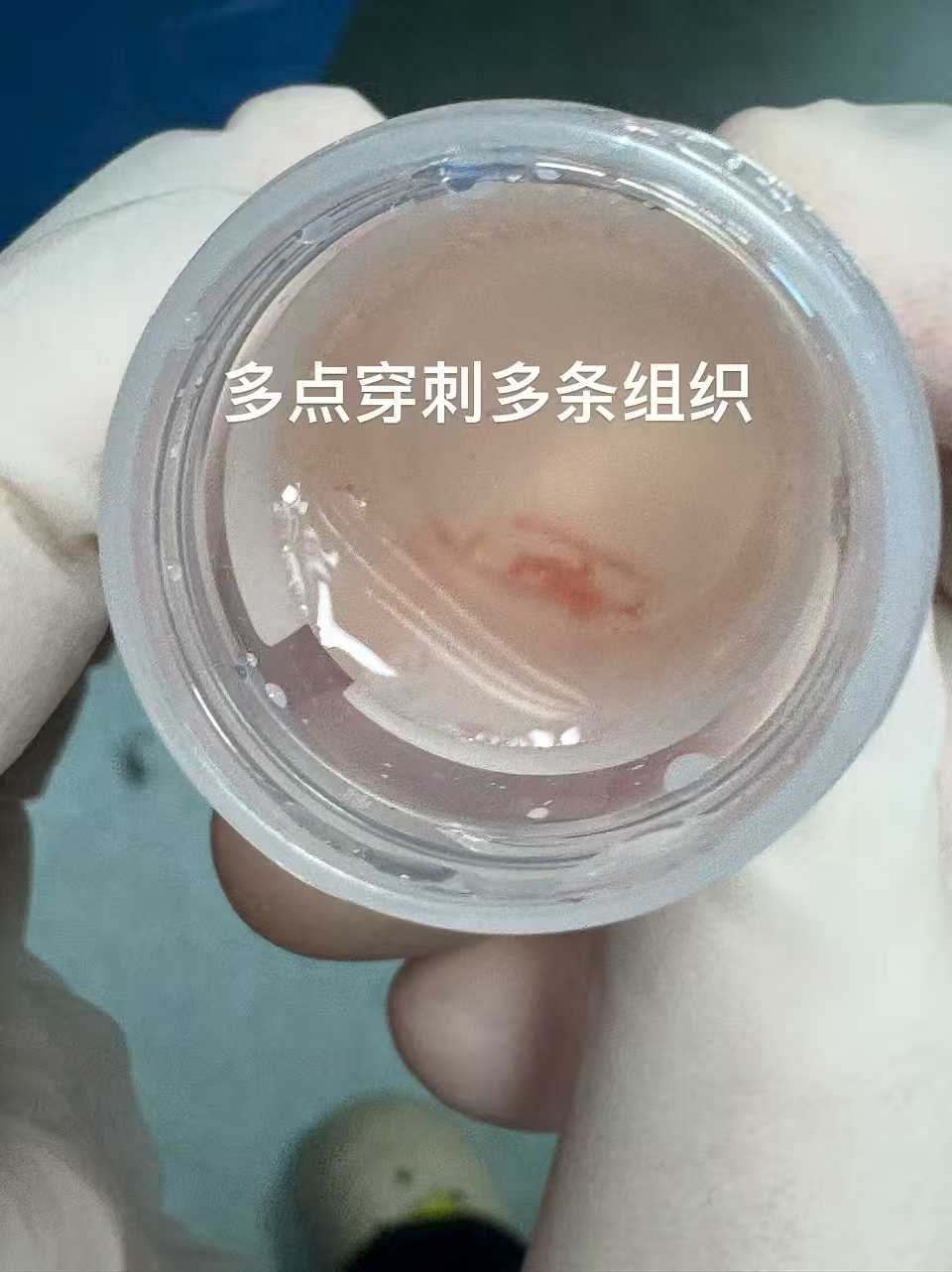 龙华肾癌权威医院排名,治疗肾癌哪个医院好？