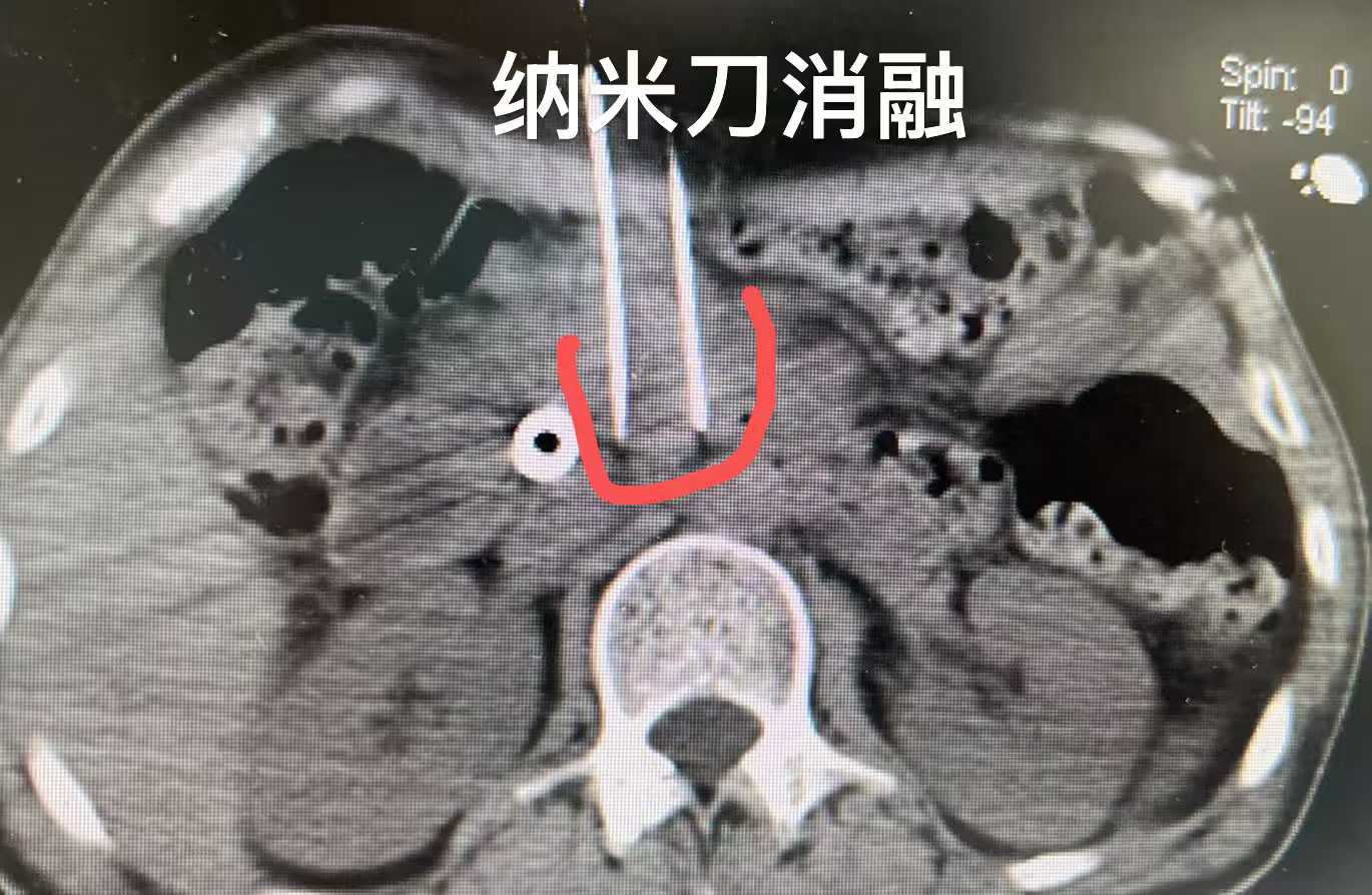 龙华治疗膀胱癌哪个医院好？选择专业医院，为您的健康护航