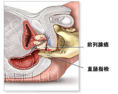 龙华飞机打多了会引起前列腺癌吗？科学解读+早筛攻略来了