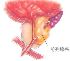 龙华中药治疗前列腺癌有效果吗,中医能治疗前列腺癌吗？